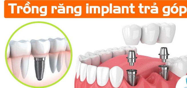 Giải pháp Trồng răng Implant trả góp đang được người dân Hà Nội, Hải Phòng, Bắc Ninh tìm kiếm trên mạng Internet nhiều nhất